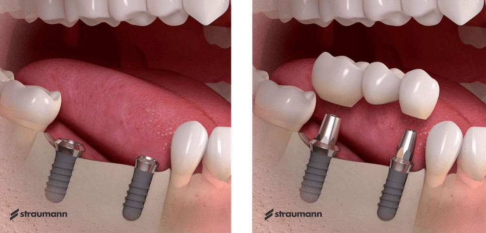 Восстановление зубов. Имплантация в ОН КЛИНИК