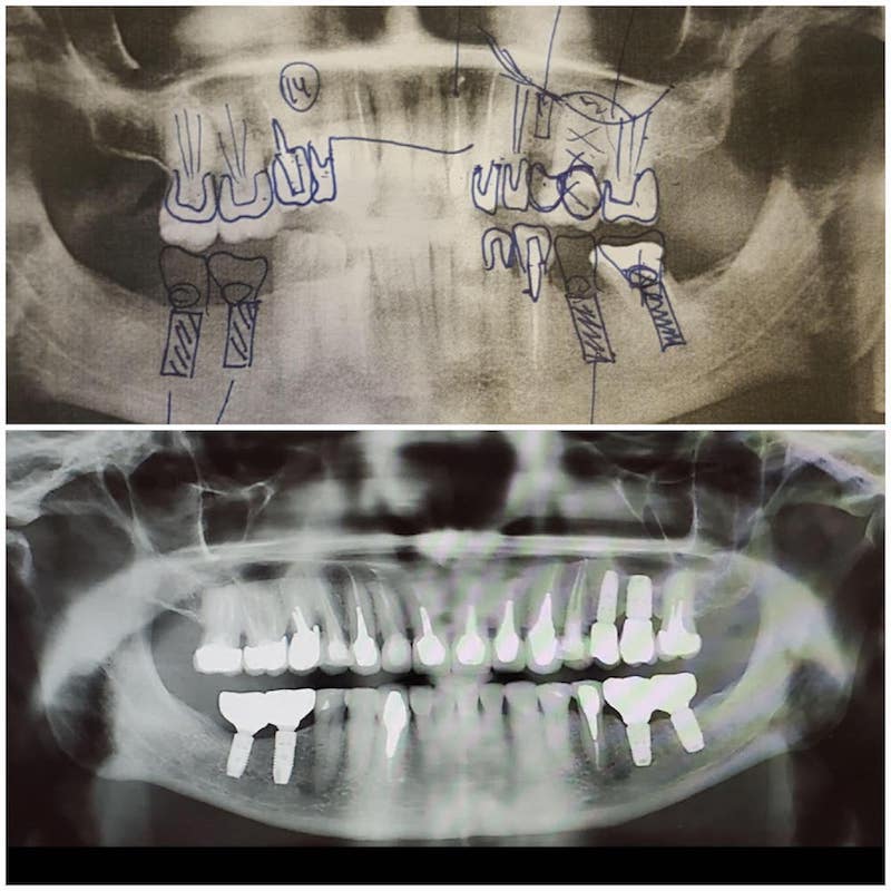 Панорамный снимок челюсти до и после имплантации