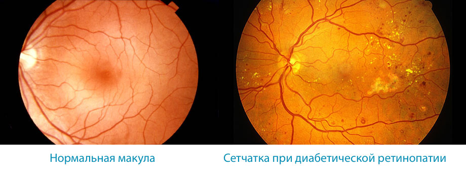 Диабетическая ретинопатия - Заболевания глаз - Справочник MSD Профессиональная версия
