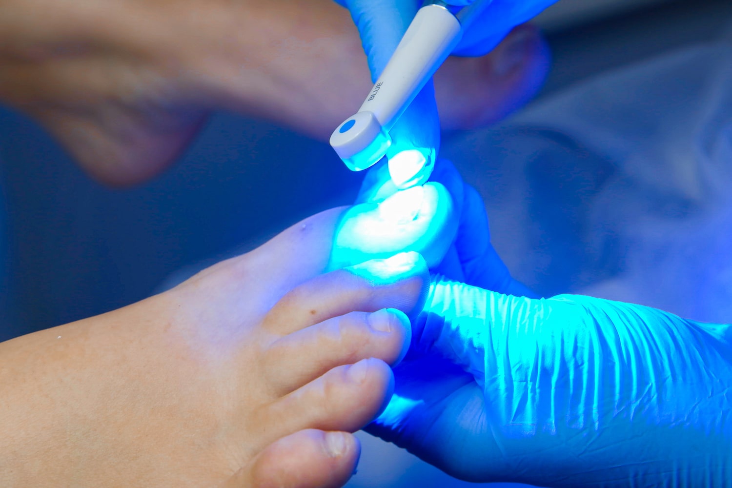 Фотодинамическая терапия грибка ногтей