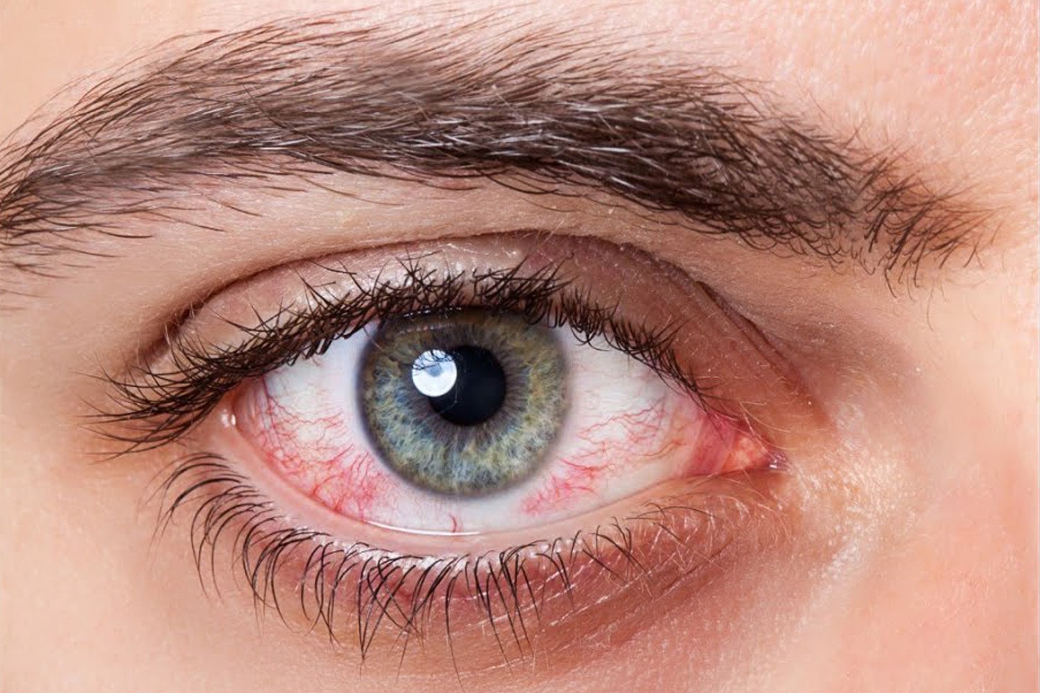 Красные глаза: причины, лечение