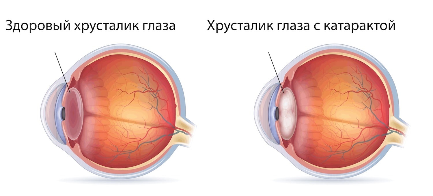 Лазерная дисцизия вторичной катаракты