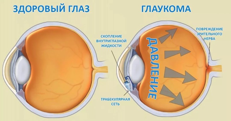Как проявляется глаукома