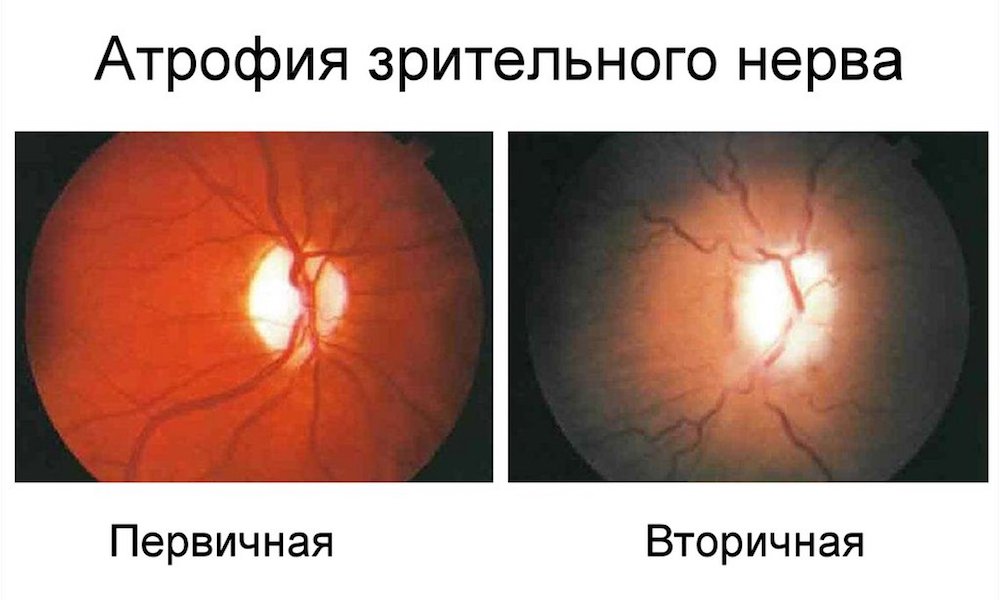 Атрофия зрительного нерва - причины, типы, симптомы, признаки, диагностика, лечение