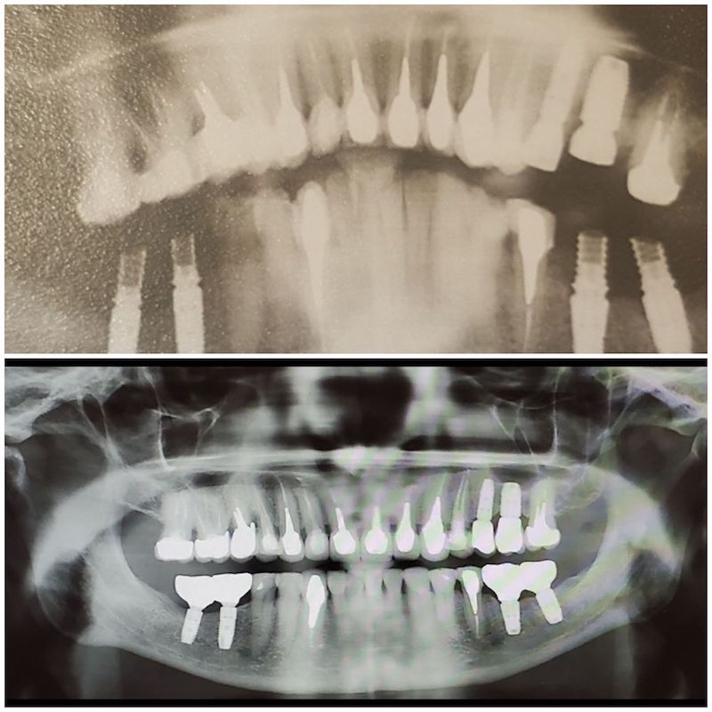 Панорамный снимок челюсти до и после имплантации
